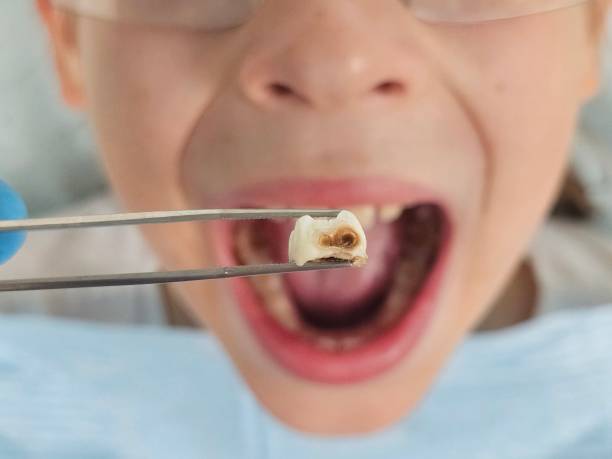 Best Emergency Wisdom Teeth Removal in Hockessin, DE
